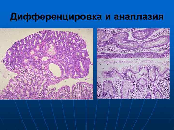 Дифференцировка и анаплазия 