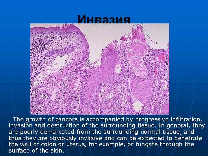 Инвазия The growth of cancers is accompanied by progressive infiltration, invasion and destruction of