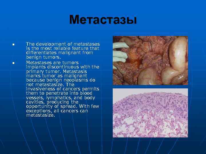 Метастазы n n The development of metastases is the most reliable feature that differentiates