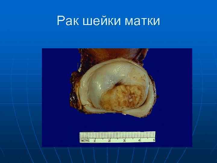 Рак шейки матки 