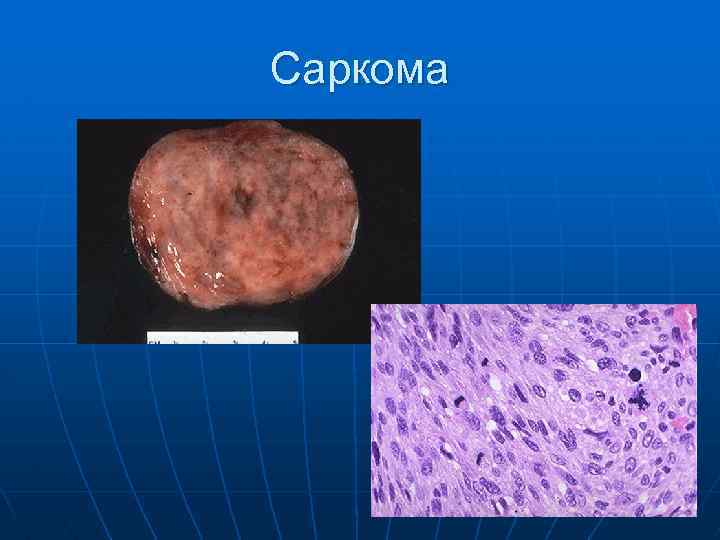 Саркома 