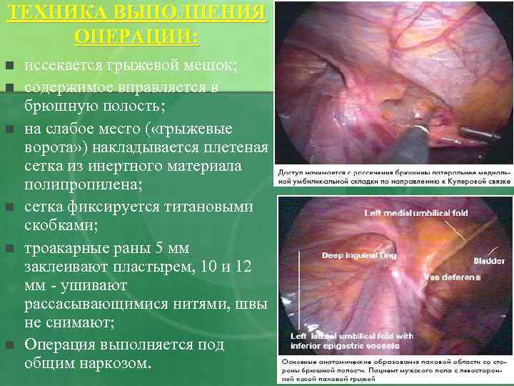 ТЕХНИКА ВЫПОЛНЕНИЯ ОПЕРАЦИИ: n n n иссекается грыжевой мешок; содержимое вправляется в брюшную полость;
