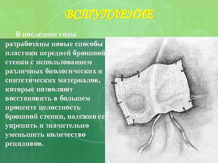 ВСТУПЛЕНИЕ В последние годы разработаны новые способы пластики передней брюшной стенки с использованием различных