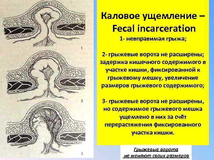 Каловое ущемление – Fecal incarceration 1 - невправимая грыжа; 2 - грыжевые ворота не