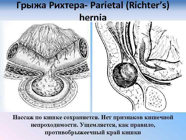 Грыжи факультетская хирургия презентация