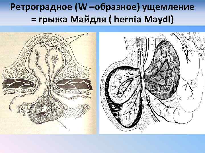 Ретроградное (W –образное) ущемление = грыжа Майдля ( hernia Maydl) 