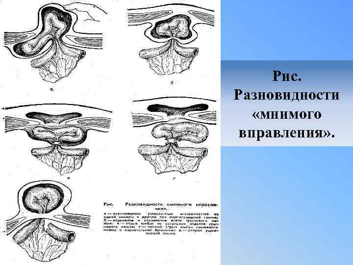 Рис. Разновидности «мнимого вправления» . 