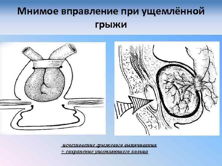 Мнимое вправление при ущемлённой грыжи исчезновение грыжевого выпячивания + сохранение ущемляющего кольца 