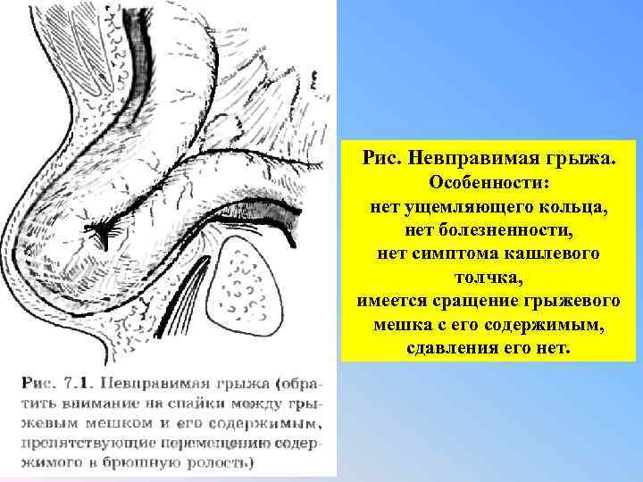 Рис. Невправимая грыжа. Особенности: нет ущемляющего кольца, нет болезненности, нет симптома кашлевого толчка, имеется