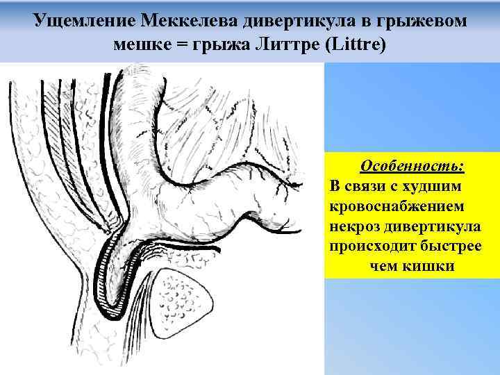 Ущемление Меккелева дивертикула в грыжевом мешке = грыжа Литтре (Littre) Особенность: В связи с