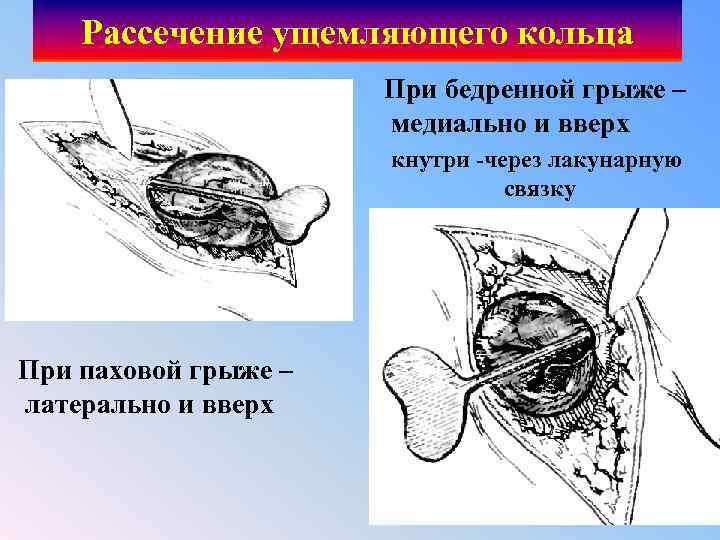 Рассечение ущемляющего кольца При бедренной грыже – медиально и вверх кнутри через лакунарную связку