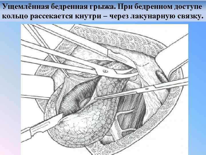 Паховая грыжа рисунок