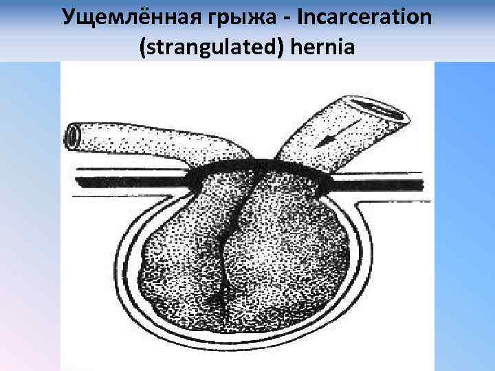 Ущемлённая грыжа - Incarceration (strangulated) hernia 