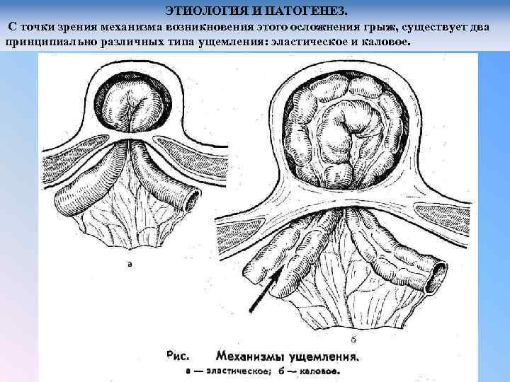 ЭТИОЛОГИЯ И ПАТОГЕНЕЗ. С точки зрения механизма возникновения этого осложнения грыж, существует два принципиально