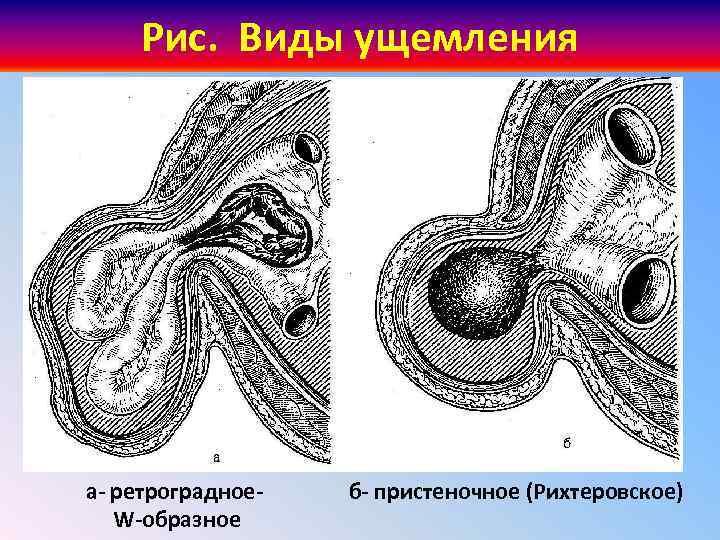 Рис. Виды ущемления а- ретроградное- б- пристеночное (Рихтеровское) W-образное 