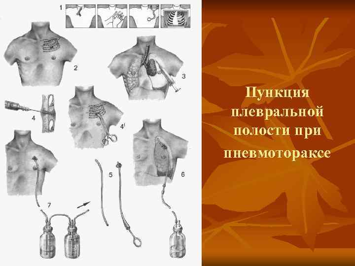 Пункция плевральной полости при пневмотораксе 