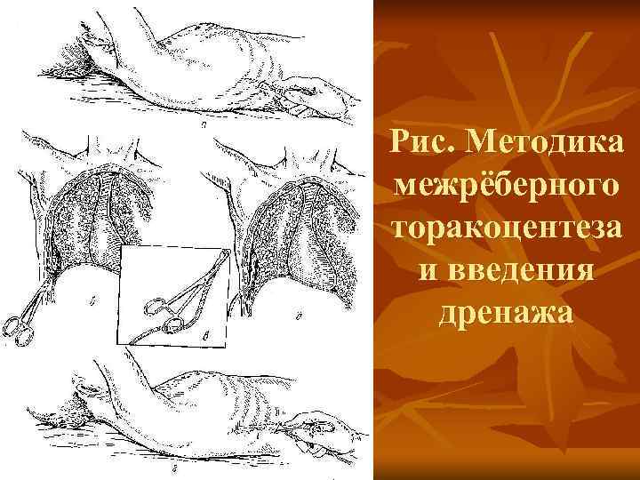Рис. Методика межрёберного торакоцентеза и введения дренажа 