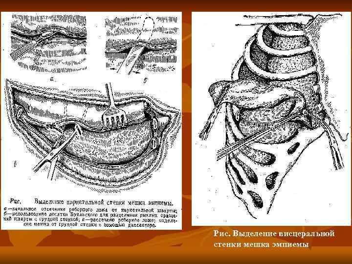 Рис. Выделение висцеральной стенки мешка эмпиемы 
