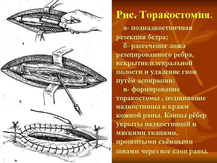Рис. Торакостомия. а- поднадкостничная резекция бедра; б- рассечение ложа резецированного ребра, вскрытие плевральной полости