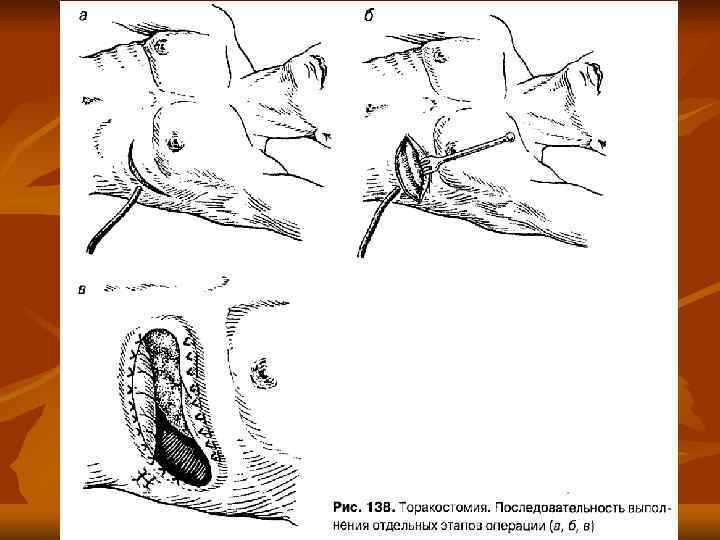 Penectomy Surgery Pictures