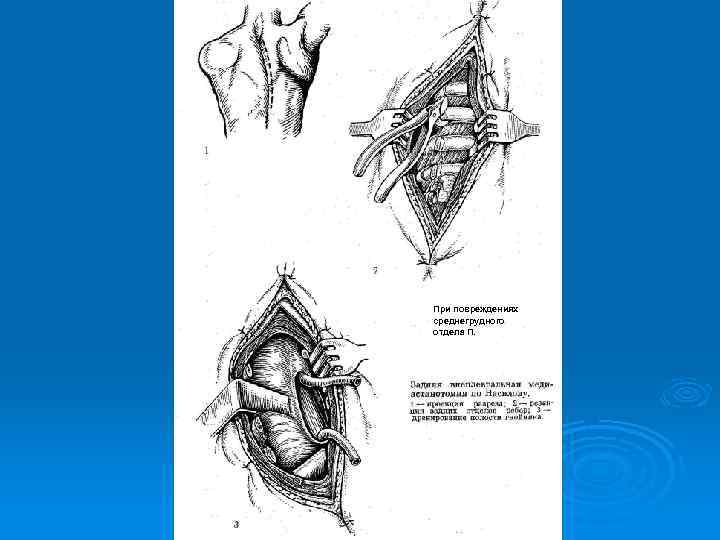При повреждениях среднегрудного отдела П. П р и 