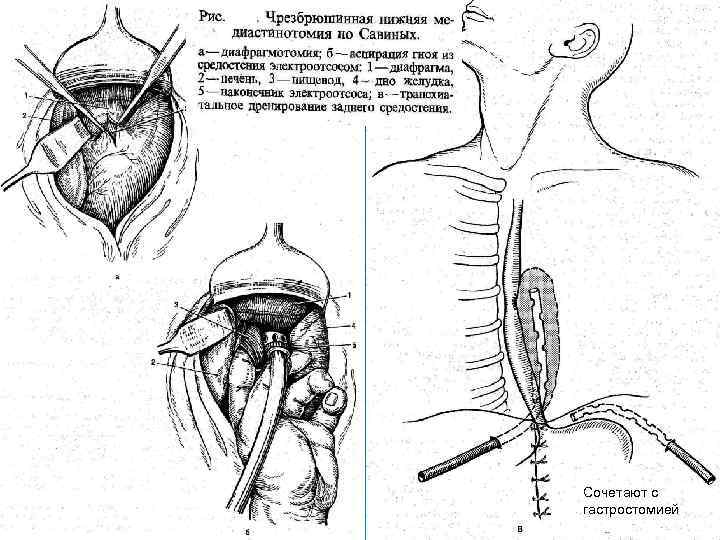 Заболевания пищевода факультетская хирургия презентация