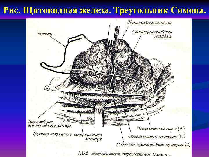 Рис. Щитовидная железа. Треугольник Симона. 
