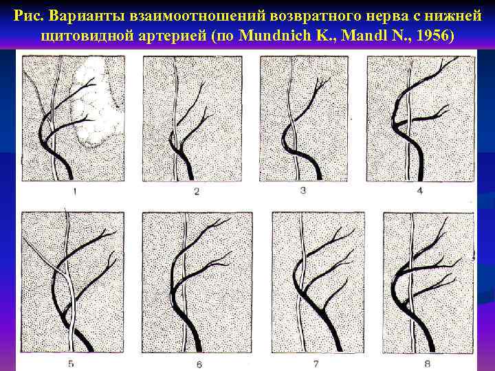 Рис. Варианты взаимоотношений возвратного нерва с нижней щитовидной артерией (по Mundnich K. , Mandl