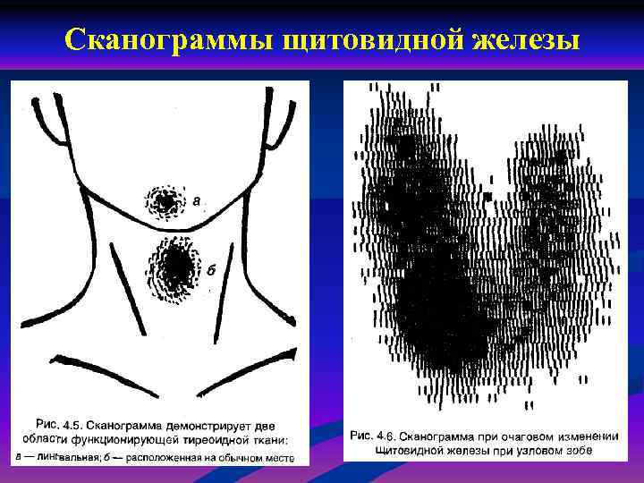 Изменения щитовидной. Сканограмма щитовидной железы в норме. Сегменты щитовидной железы. Сканограмма щитовидной железы патологии. Узел на сканограмме щитовидной железы..