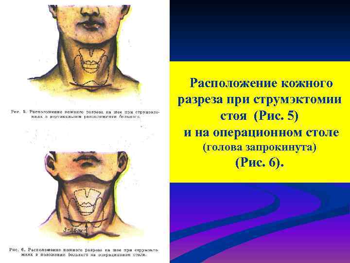 Расположение кожного разреза при струмэктомии стоя (Рис. 5) и на операционном столе (голова запрокинута)