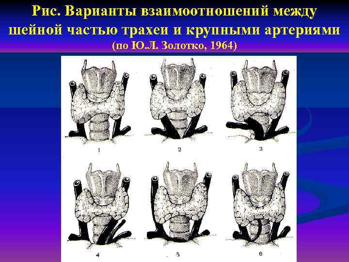 Рис. Варианты взаимоотношений между шейной частью трахеи и крупными артериями (по Ю. Л. Золотко,