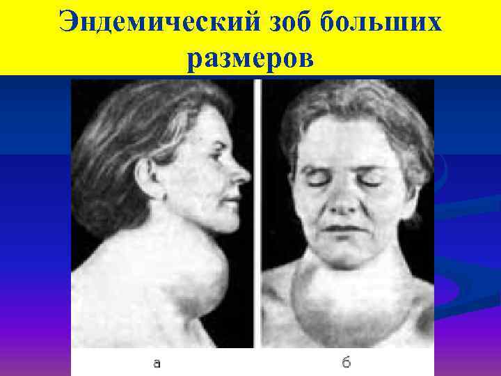 Эндемический зоб больших размеров 