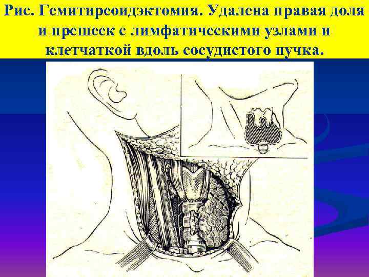 Рис. Гемитиреоидэктомия. Удалена правая доля и прешеек с лимфатическими узлами и клетчаткой вдоль сосудистого