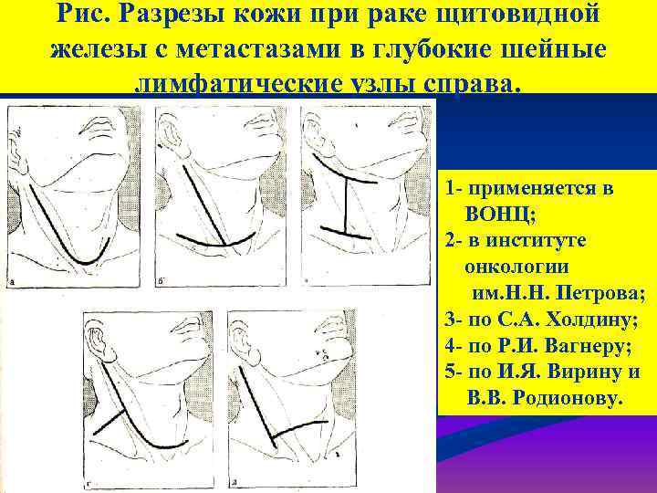 Рис. Разрезы кожи при раке щитовидной железы с метастазами в глубокие шейные лимфатические узлы
