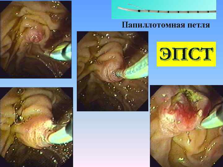 Папиллотомная петля ЭПСТ 