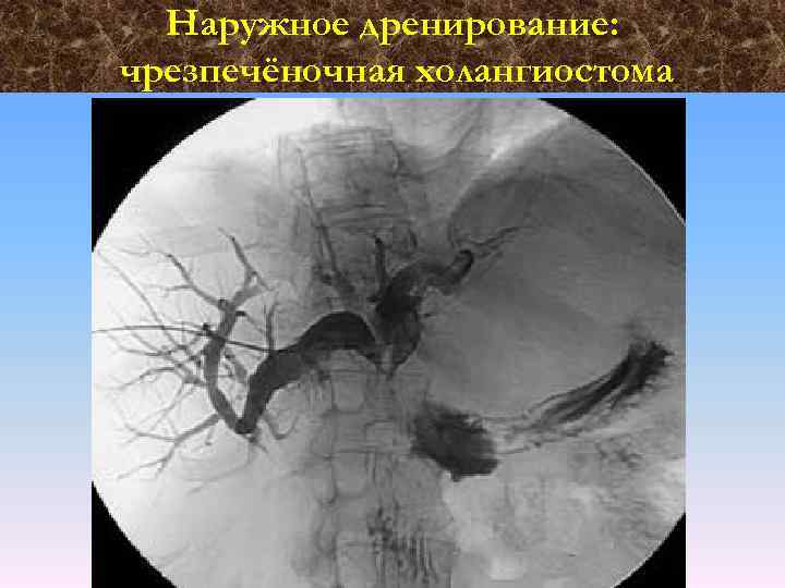 Наружное дренирование: чрезпечёночная холангиостома 
