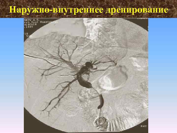 Наружно внутреннее дренирование 