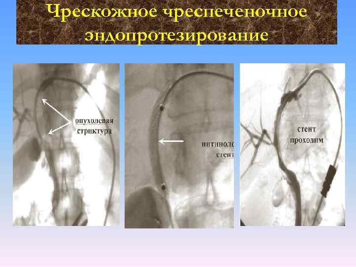 Чрескожное чреспеченочное эндопротезирование 