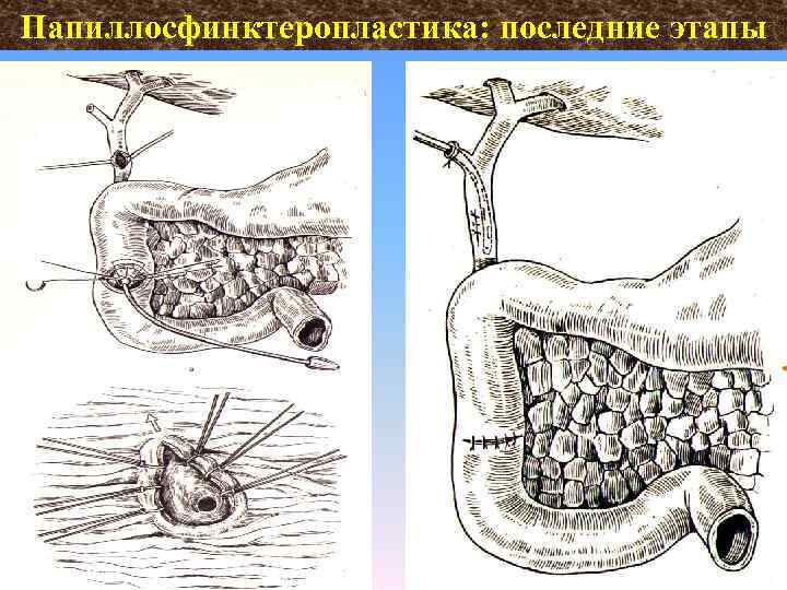 Папиллосфинктеропластика: последние этапы 