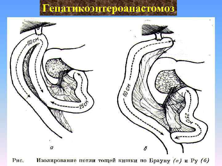 Гепатикоэнтероанастомоз 