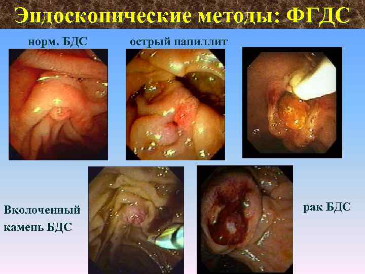 Эндоскопические методы: ФГДС норм. БДС Вколоченный камень БДС острый папиллит рак БДС 