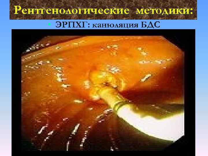 Рентгенологические методики: • ЭРПХГ: канюляция БДС 