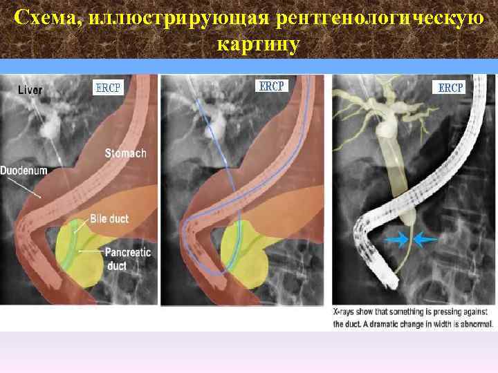 Холедохолитиаз факультетская хирургия презентация