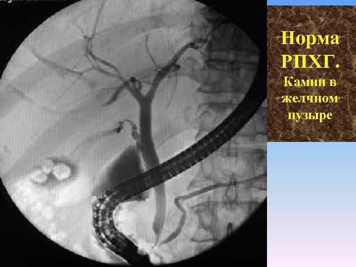 Норма РПХГ. Камни в желчном пузыре 