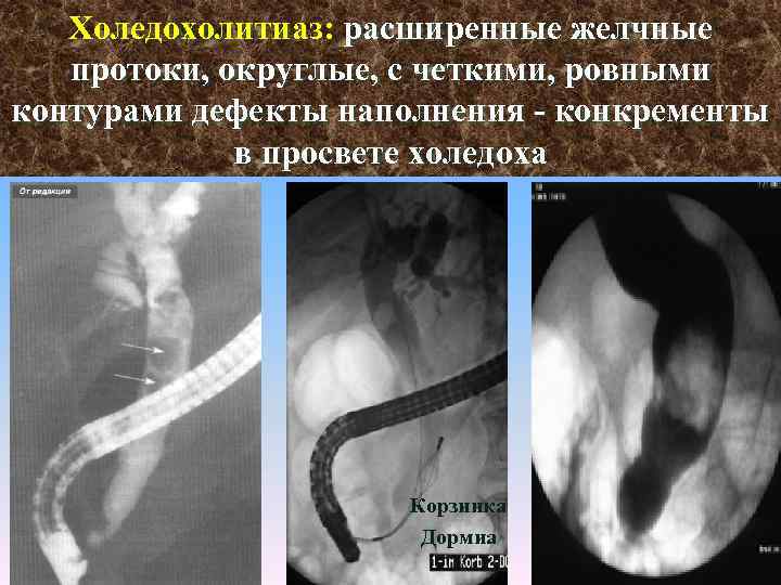 Холедохолитиаз: расширенные желчные протоки, округлые, с четкими, ровными контурами дефекты наполнения конкременты в просвете