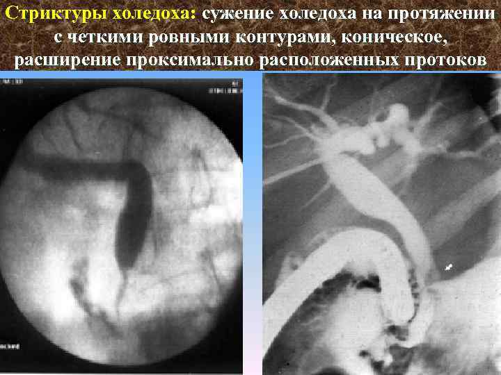 Стриктуры холедоха: сужение холедоха на протяжении с четкими ровными контурами, коническое, расширение проксимально расположенных