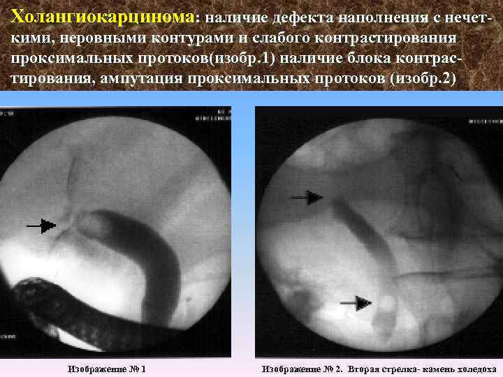 Холангиокарцинома: наличие дефекта наполнения с нечет кими, неровными контурами и слабого контрастирования проксимальных протоков(изобр.
