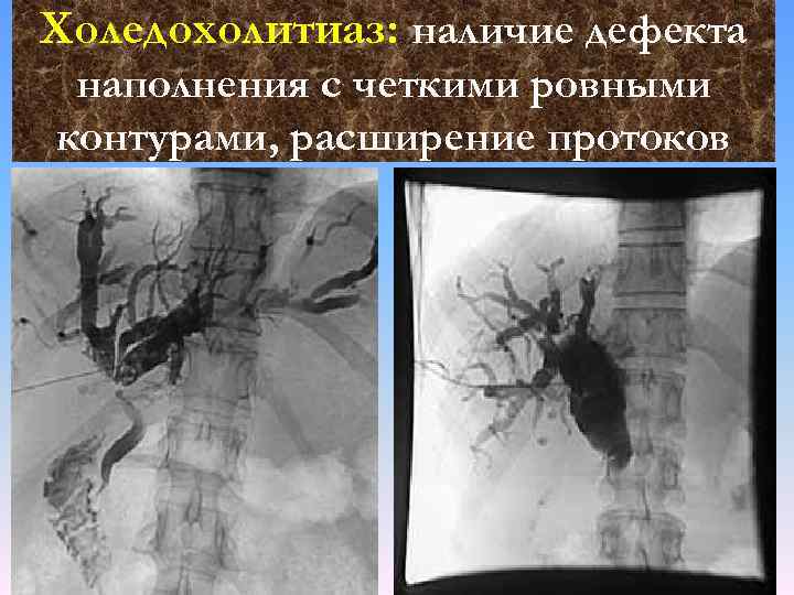 Расширение протоков. Дефект наполнения с ровными контурами. Дефект наполнения с четкими ровными контурами желудок. Холедох расширен без явных дефектов наполнения.