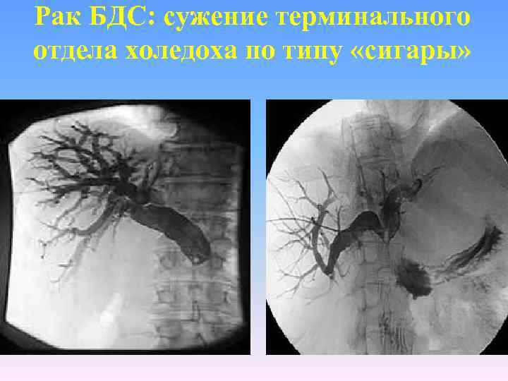Рак БДС: сужение терминального отдела холедоха по типу «сигары» 