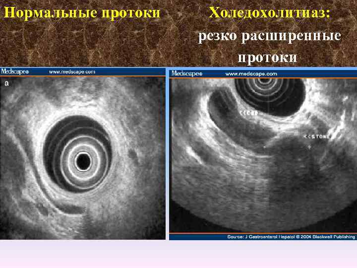 Нормальные протоки Холедохолитиаз: резко расширенные протоки 